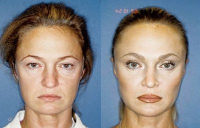 before and after brow | forehead lift female patient front view