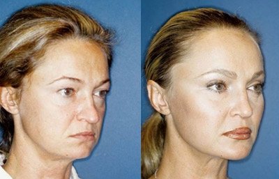 before and after brow | forehead lift female patient right angle view