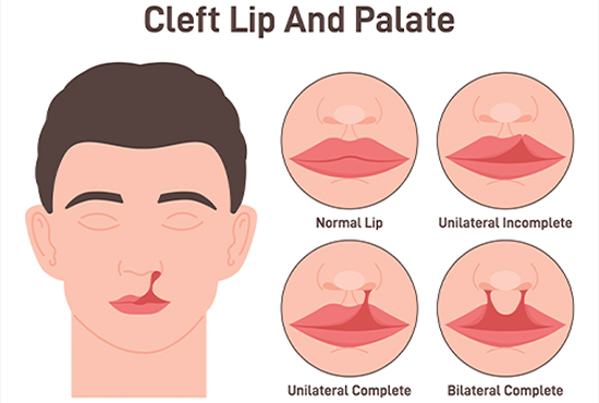 Cleft Lip and Palate - Stepanyan Surgical Arts Center