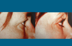 before and after eyelid surgery left side eye view female patient case 2479