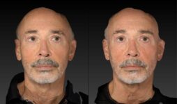 before and after eyelid surgery male patient front view case 3132