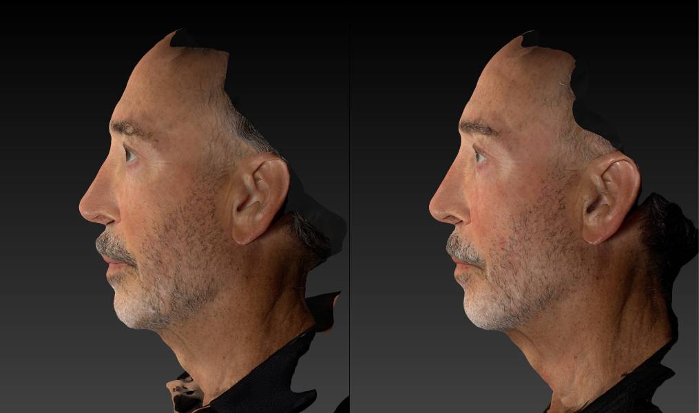 before and after eyelid surgery male patient left side view case 3132