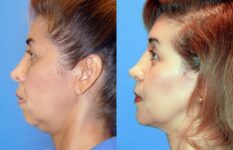 before and after eyelid surgery left side view case 2490