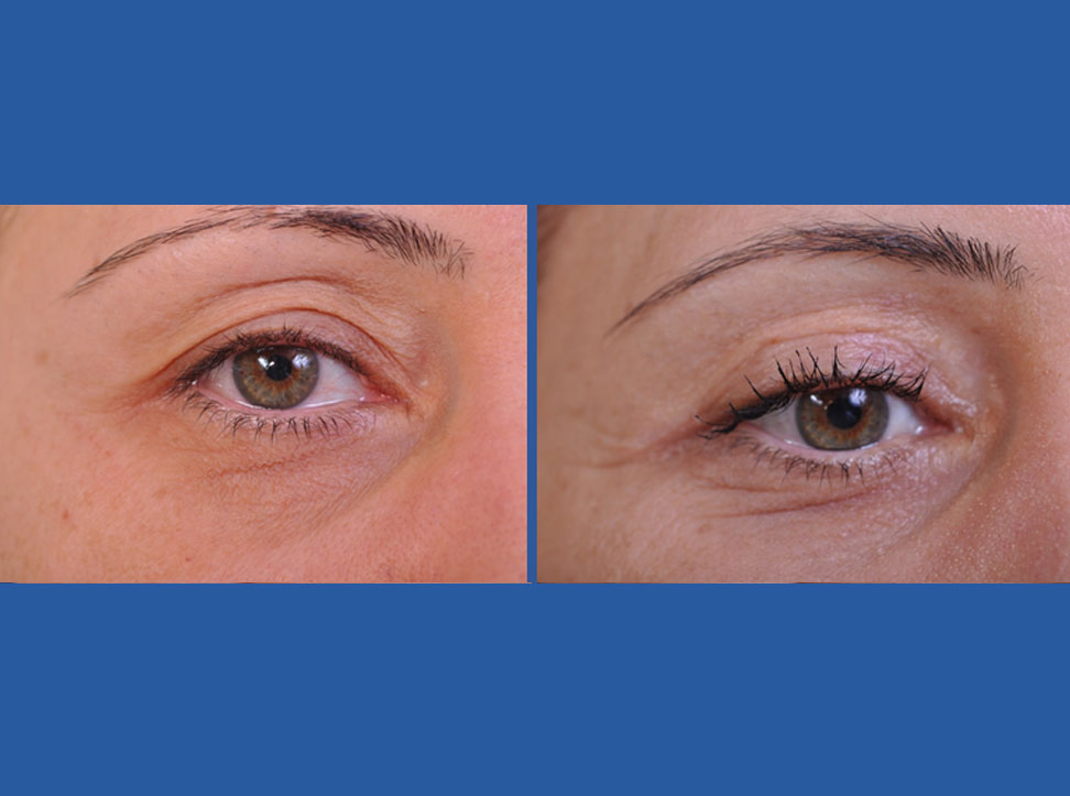 before and after blepharoplasty female patient closeup of right eye case 2454