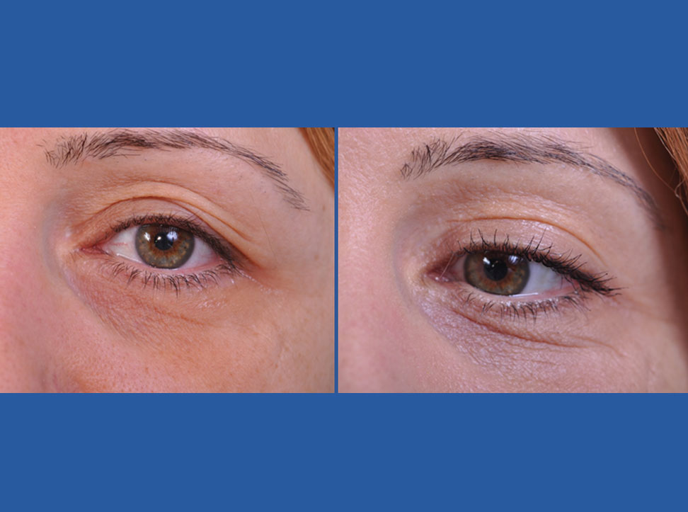 before and after blepharoplasty female patient closeup of left eye case 2454