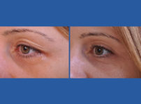 before and after blepharoplasty female patient left angle view case 2454