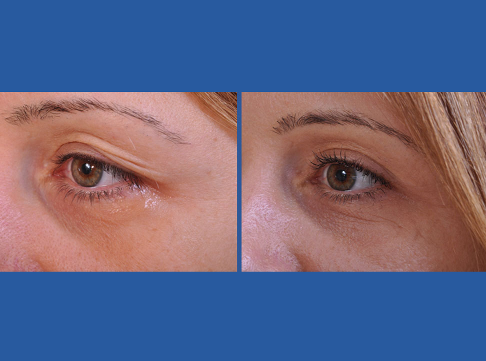 before and after blepharoplasty female patient left angle view case 2454
