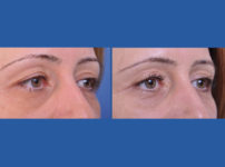before and after blepharoplasty female patient right angle view case 2454