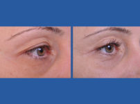 before and after blepharoplasty female patient right eye view case 2454