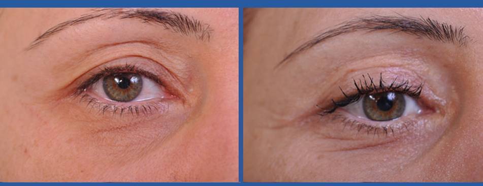 before and after blepharoplasty female patient closeup of right eye view case 2454