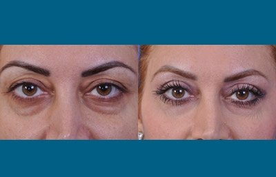 before and after blepharoplasty female patient front view case 2475