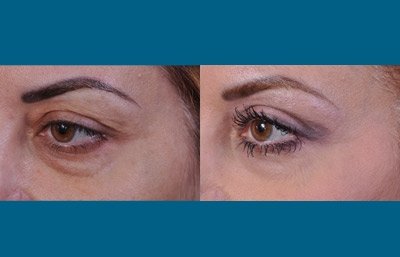 before and after blepharoplasty female patient left angle view closeup of right eye case 2475