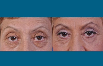 before and after blepharoplasty female patient closeup of eyes front view case 2484