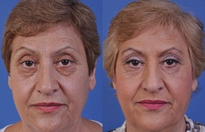 before and after blepharoplasty female patient front view case 2484