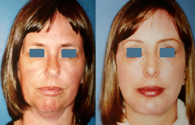 before and after brow lift | forehead lift female patient front view case 2365