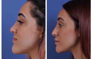 before and after chin reduction female patient left side view case 2166