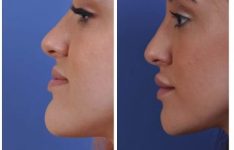 before and after chin reduction female patient left side view case 2166