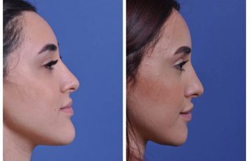 before and after chin reduction female patient right side view case 2166