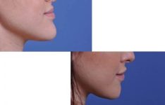 before and after chin reduction female patient right side view case 2166