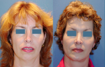 before and after chin augmentation female patient front view case 2185