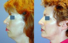 before and after chin augmentation left side view case 2185