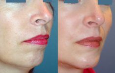 before and after chin augmentation female patient right angle view case 2185