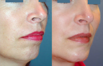 before and after chin augmentation female patient right angle view case 2185