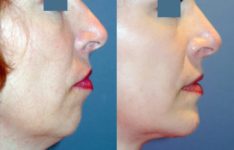 before and after chin augmentation female patient right side view case 2185