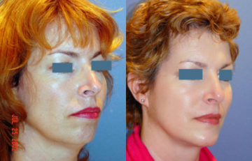 before and after chin augmentation right angle view case 2185
