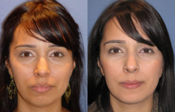 before and after chin augmentation female patient front view case 2607