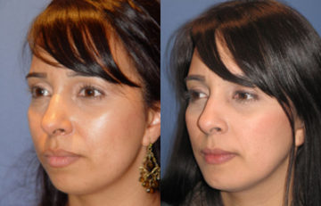 before and after chin augmentation female patient left angle view case 2607