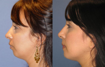 before and after chin augmentation female patient left side view case 2607