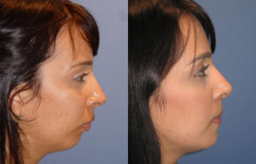 before and after chin augmentation female patient right side view case 2607
