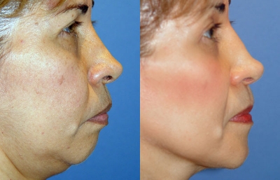 before and after chin augmentation | chin reduction right side view case 3372