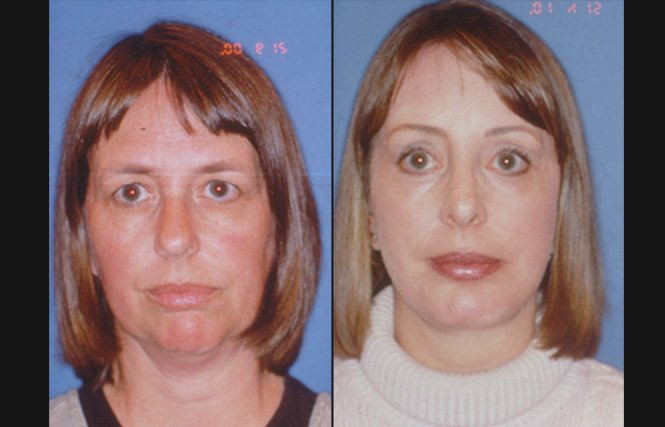 before and after chin augmentation front view female patient case 3453