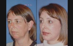 before and after chin augmentation left angle view female patient case 3453