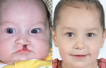 before and after cleft lip and palate front view case 2652