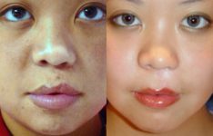 before and after cleft lip and palate female patient front view case 2655