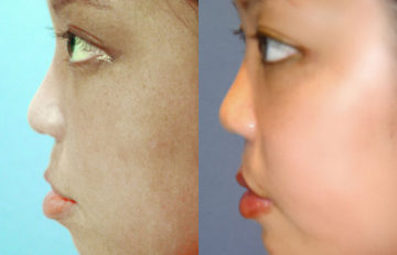 before and after cleft lip and palate female patient left side view case 2655