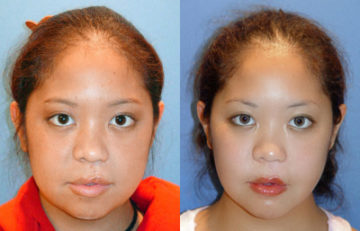 before and after cleft lip and palate female patient front view case 2655