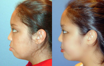 before and after cleft lip and palate female patient left side view case 2655