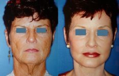 before and after brow lift | forehead lift female patient front view case 2358