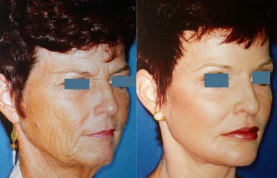before and after brow lift | forehead lift female patient right angle view case 2358