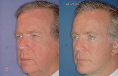 before and after brow lift | forehead lift male patient left angle view case 2377