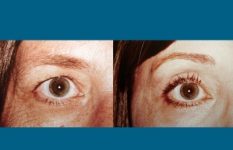 before and after brow lift | forehead lift female patient closeup right eye view case 2389