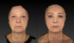 before and after brow lift | forehead lift female patient front view case 3119