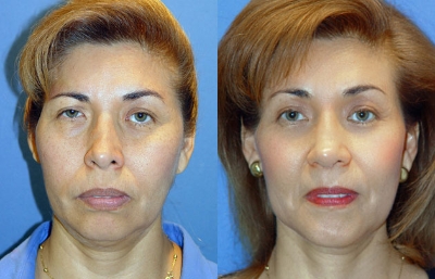 before and after brow lift | forehead lift front view case 3353
