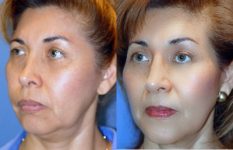 before and after brow lift | forehead lift left angle view case 3353