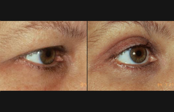 before and after blepharoplasty right angle view case 2469