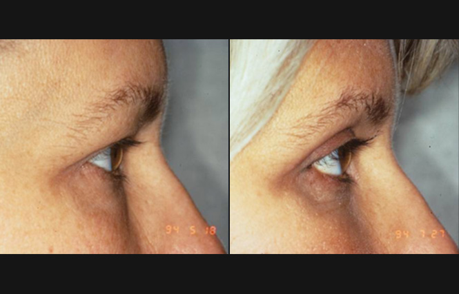 before and after blepharoplasty right side view case 2469